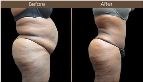 Before And After Gluteal Fat Grafting